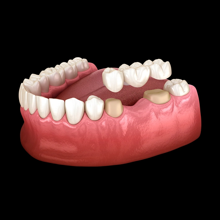 Rebuild Your Smile And Restore Function With Dental Bridges