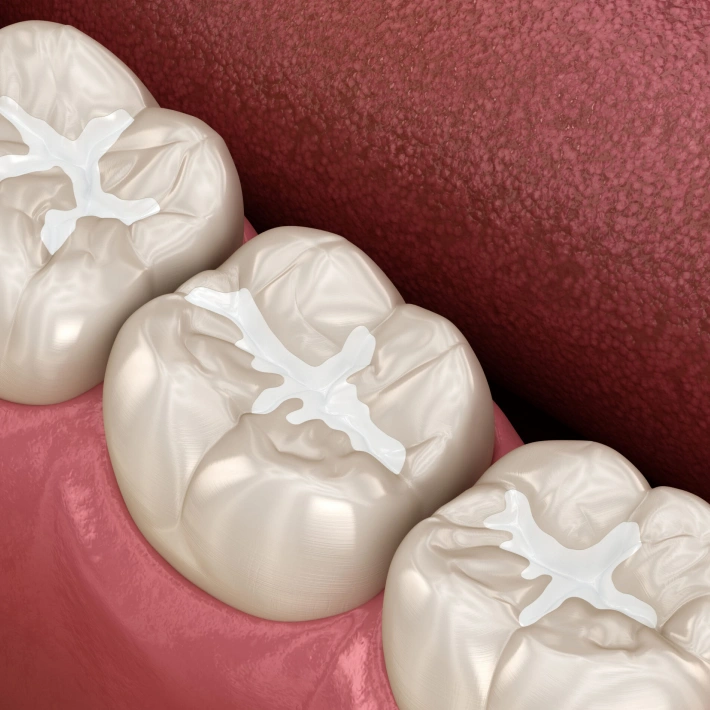 Simple Care Solutions for Lasting Smiles