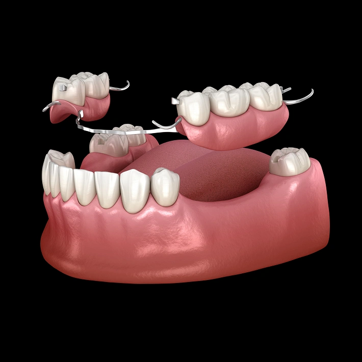 Simple Care Solutions for Lasting Smiles