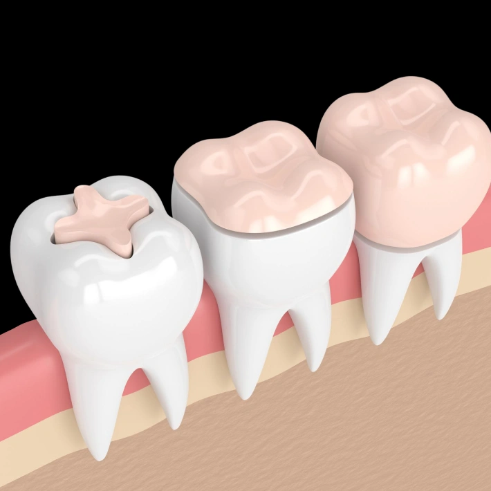 Protect and Restore Your Teeth